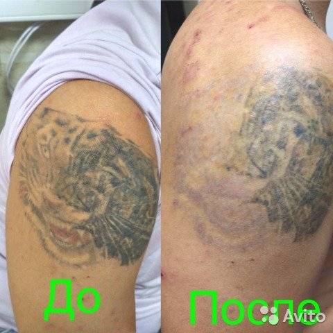 Как удалить цветную татуировку