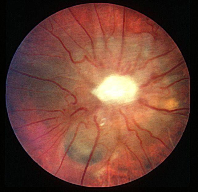 Как выглядит атрофия зрительного нерва