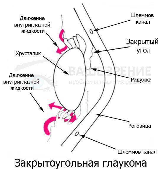 Схема закрытоугольной глаукомы