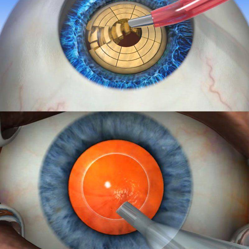 Факоэмульсификация катаракты с имплантацией иол, что это: установка хрусталика в глазу