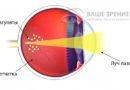 Лазерная коагуляция сетчатки — спасение от слепоты