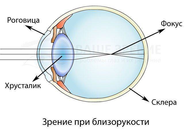Зрение при миопии