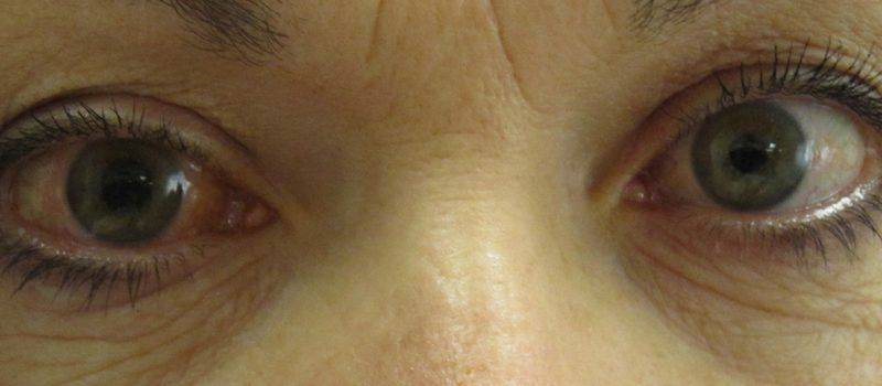 Давление внутри глаза при глаукоме