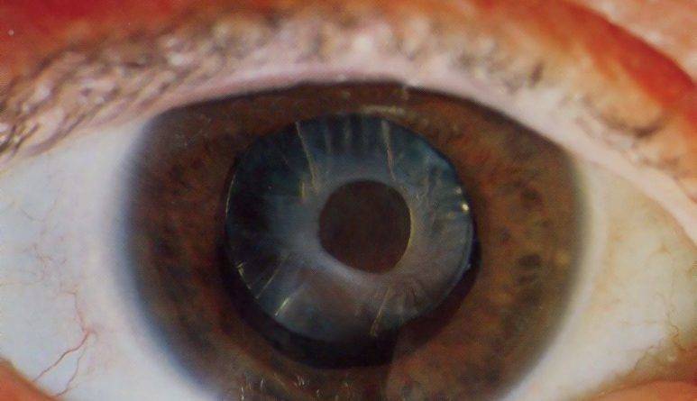 Заднекапсулярная катаракта