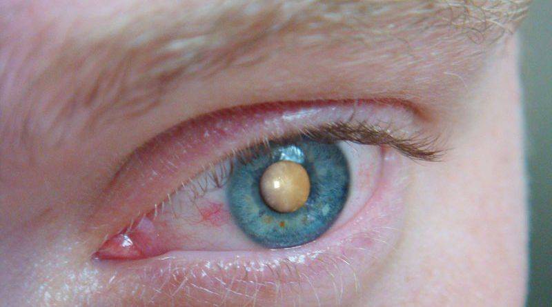 Сенильная катаракта
