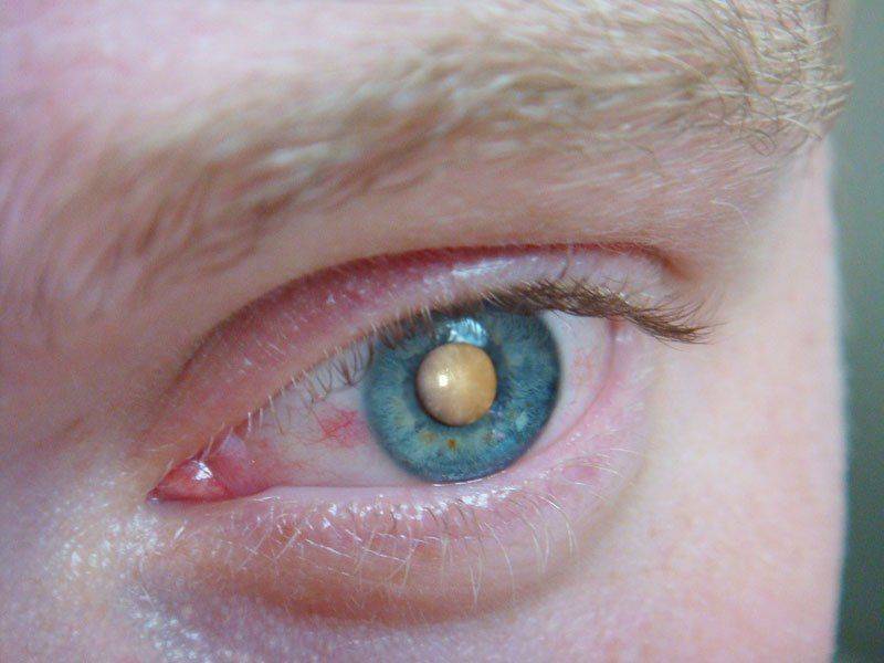 Сенильная катаракта