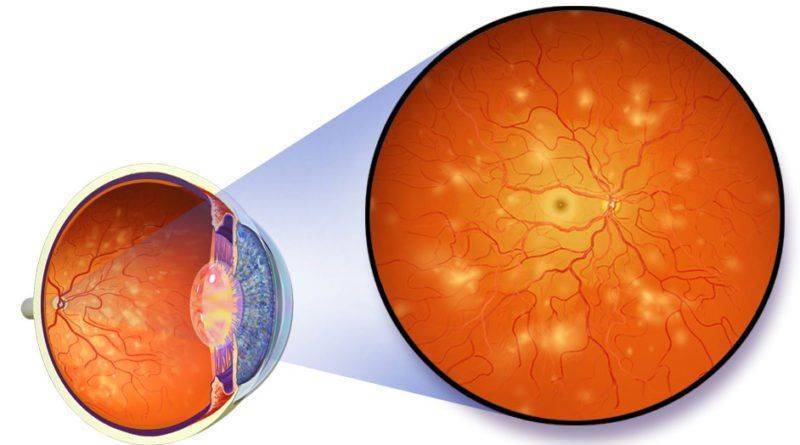 Диабетическая ретинопатия: что такое