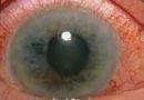 Как проводят диагностику глаукомы