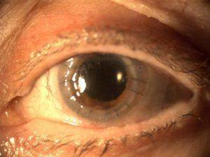 Глаз после кератопластики