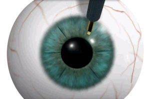 Кератотомия глаза