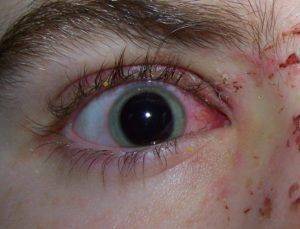 Травма глаза