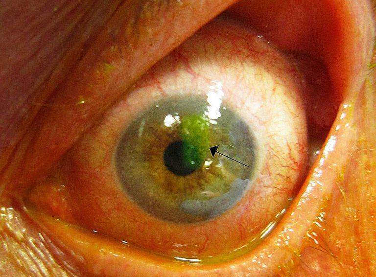 Эрозия роговицы глаза: причины, лечение, последствия