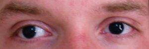 Аниридия глаза