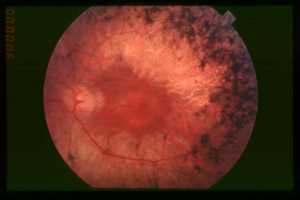 Глазное дно при пигментном ретините