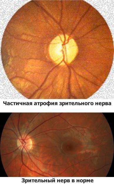 Опасно или нет наращивать ресницы во время беременности