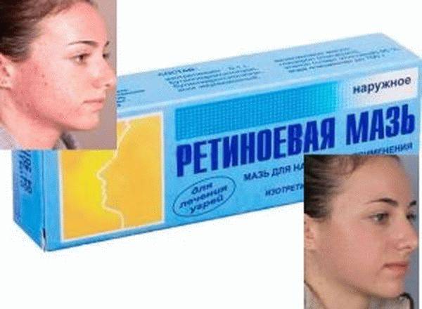 Ретиноевая мазь от морщин: отзывы косметологов