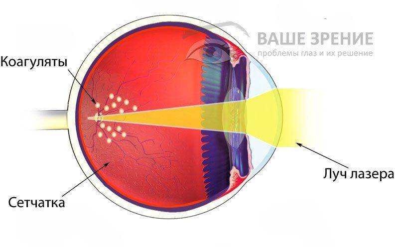 Влияние лазера на сетчатку глаза thumbnail