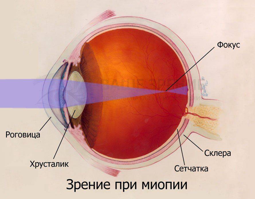 Миопия глаз сетчатки при беременности thumbnail