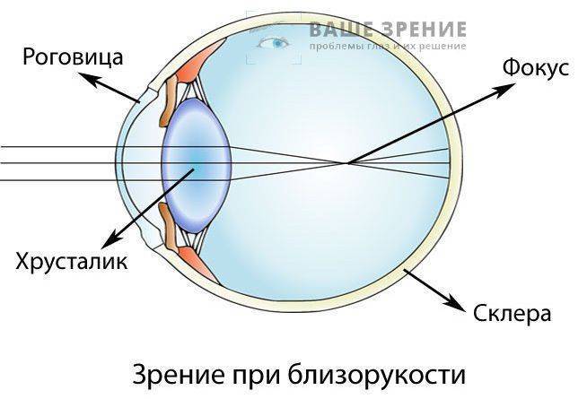 Как выглядит глаз при близорукости