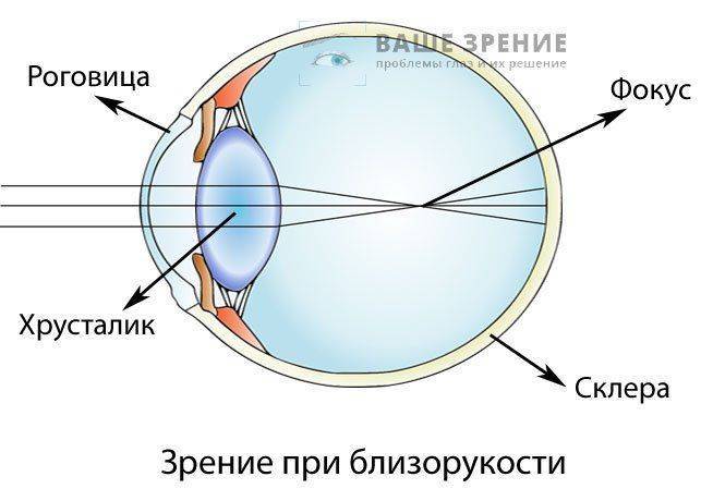 Как выглядит глаз при близорукости