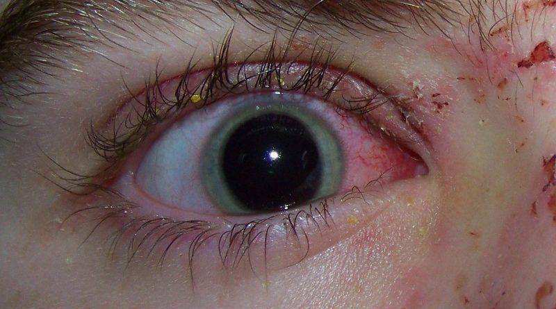 Глазная травма приводит к расширению зрачка